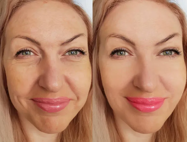 Types of Fillers for the Face