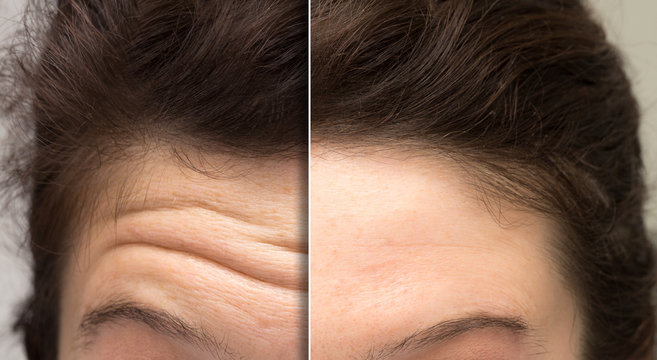 Botox treatments for hair