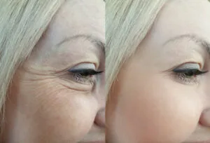 Botox, Microneedling Stretch Mark Removal