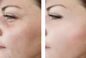 botox, Microneedling vs RF Microneedling