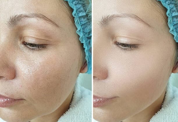 Microneedling For Enlarged Pores Does It Make A Difference Microneedling For Enlarged Pores Does It Make A Difference