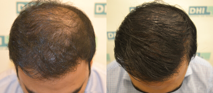PRP Injections for Hair Loss
