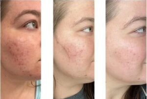 Microneedling Treatment in Miramar, Is Microneedling Safe?