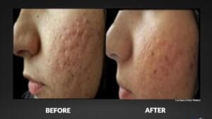 Cellenis Dermal PRP, Post-Acne Microneedling Scars