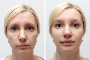 dermal filler in Miramar, FL