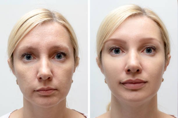 dermal filler in Miramar, FL
