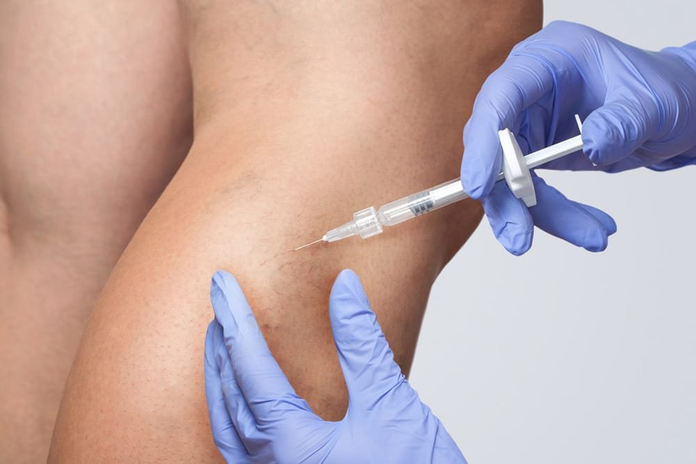 Sclerotherapy in miramar hollywood