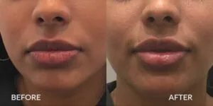 types of lip fillers, Lip Filler Appointment