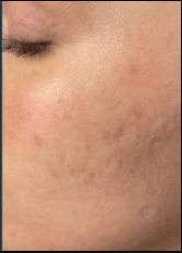 Acne Scar Treatment Miramar FL