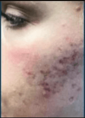 VI Peel vs Microneedling