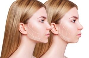 is-botox-bad-for-you, jawline filler