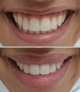 Lip Flip, Lip Flip Results