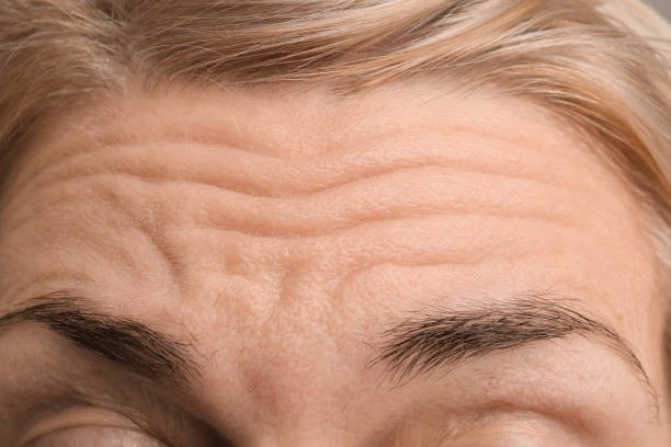 wrinkle relaxer treatments