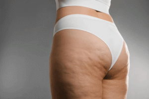 Maintaining Skin Tightness & Cellulite Reduction