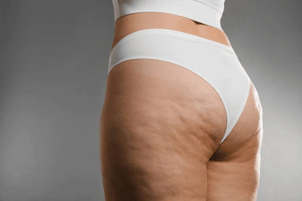Cellulite Treatment