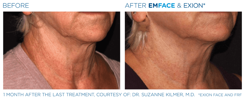 Exion Before and after Treatment