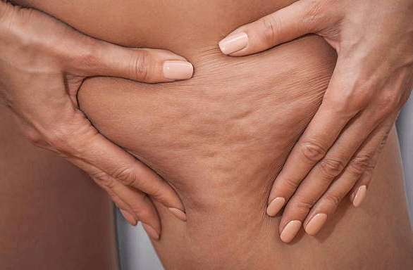 Cellulite Treatment in Florida