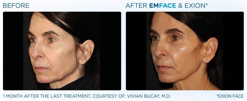 Exion Before and after Treatment
