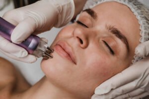RF Microneedling Cooper City
