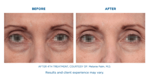 EMFACE Treatment in Florida, EMFACE Treatment Miami