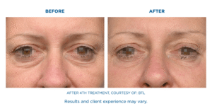 EMFACE Treatment in Florida