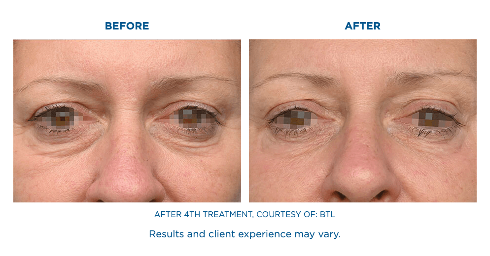 EMFACE Treatment in Florida