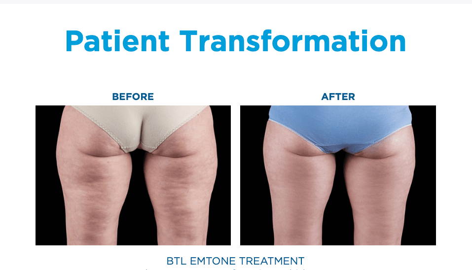 Emtone Treatment Florida