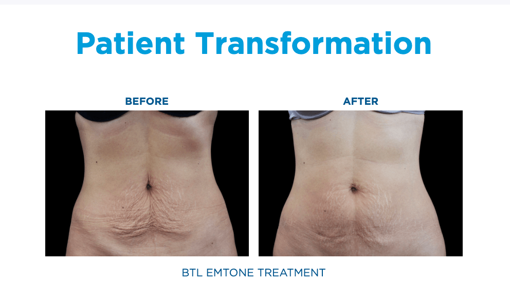 Emtone Treatment Florida
