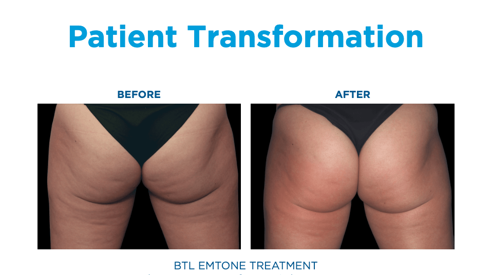 Emtone Treatment in Florida