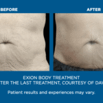 Exion Body Contouring in Florida: Non-Surgical Body Fat Reduction