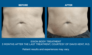Exion Body Contouring in Florida