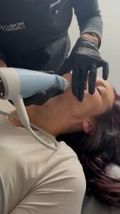 rf microneedling florida, Exion Treatment