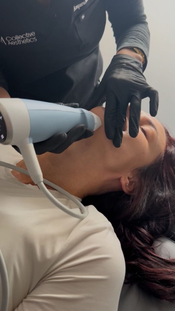 rf microneedling florida, Exion Treatment