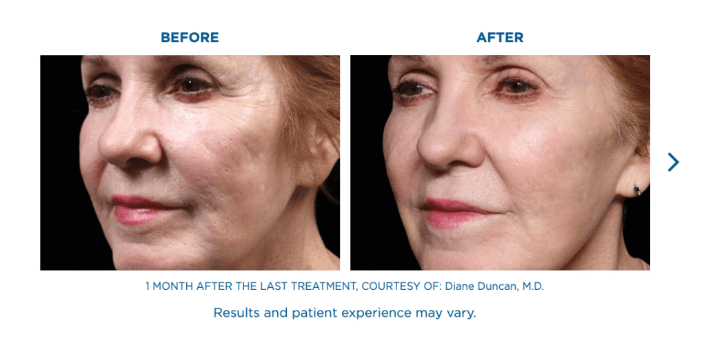 Exion Face Treatments Florida, exion RF Skin Microneedling