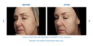 Acne Scar Treatment Miramar FL