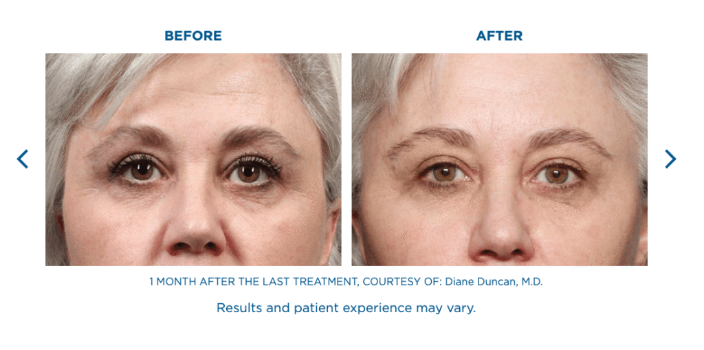 Exion Face Treatments Florida