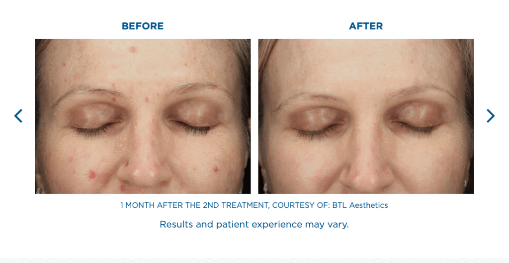VI Peel Before and After