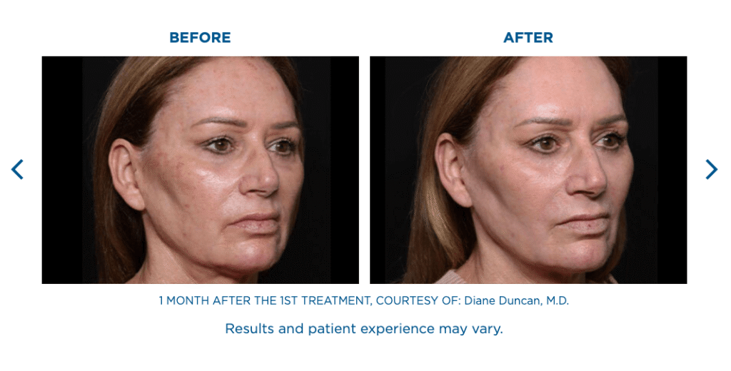 Exion Face Treatments Florida