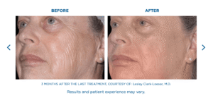 Anti Aging Skin Tightening Miramar FL