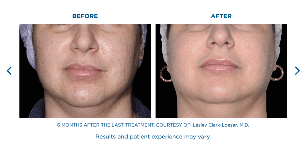 Exion Face Treatments Florida