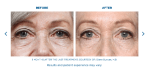 Fine Lines Treatment Miramar FL