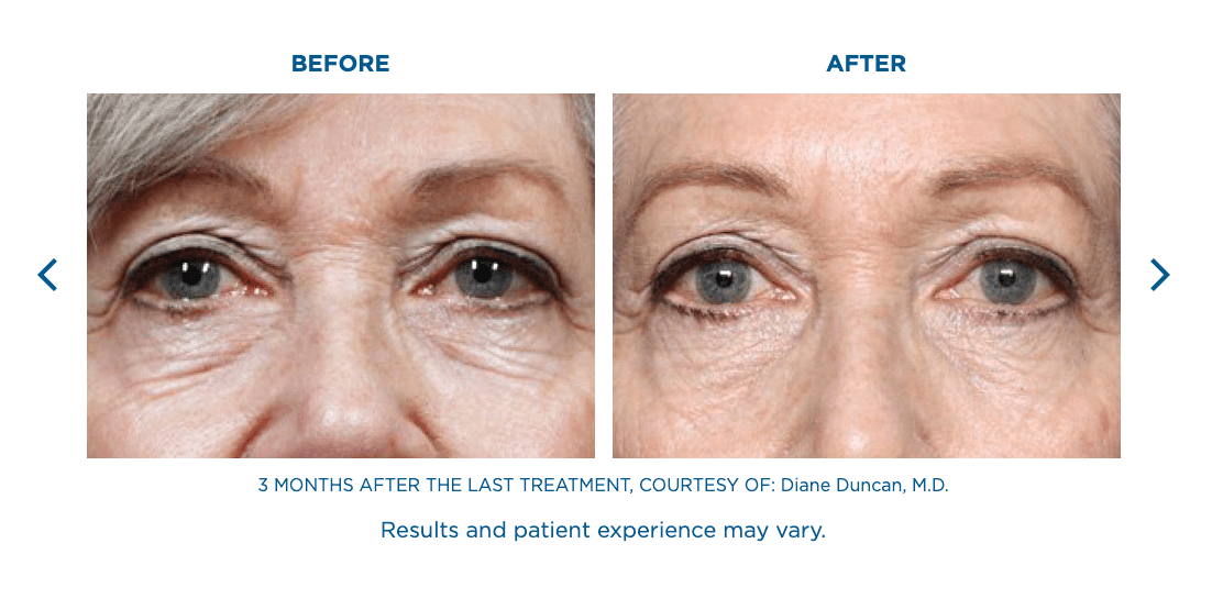 Fine Lines Treatment Miramar FL