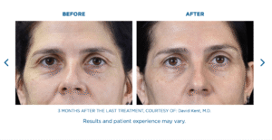 Under Eye Smoothing Treatment Miramar FL