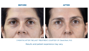 Under Eye Smoothing Treatment Miramar FL