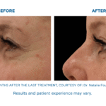 Exion Face Treatments in Florida | Your Skin’s New Game Changer