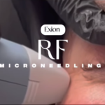 RF Microneedling Special – Get It for Just $399 (Limited Time)