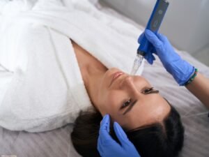 Dermal filler, RF Microneedling Miramar FL, Microneedling and RF Microneedling, How Many Microneedling Sessions Do I Need