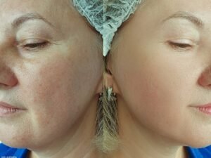 Cheek Fillers Near Me