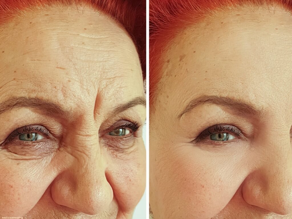 Best Fillers for Smile Lines