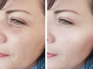 Can Fillers Look Natural